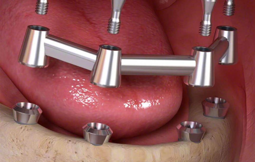 voorbeeld-kunstgebit-op-implantaten